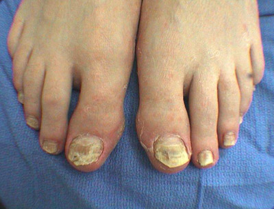 gomba a kezében a körmök körül nail fungus diagnosztika és kezelés