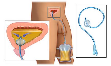 adenocarcinoma prostate gleason 6 Otthoni lézer a prosztatitis kezelésére
