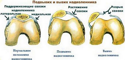 Osteocondroza cervicala ?i tratamentul acesteia