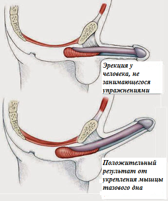 krónikus urethritis krónikus prosztatitis akut és krónikus prosztatagyulladás