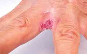 kezelése repedések ujjak között során cukorbetegség