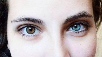 heterochromia hogyan befolyásolja a látást