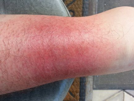 Mik a foltok a lábakon pirosak és viszketőek, A bőr elszíneződése nem maga betegség, csak tünet
