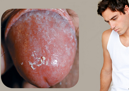 fityma gombás fertőzés férfiaknál képek