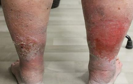 grabii piciorul sub genunchi în spatele varicosei