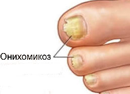 kezelés nail gombusz otthon nail fungush módszer megbízható