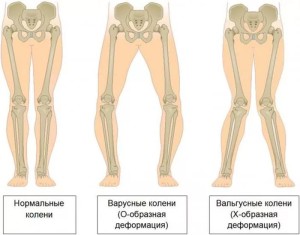 Felnőtt varus térd deformáció, A varus és valgus lábak jellemzői