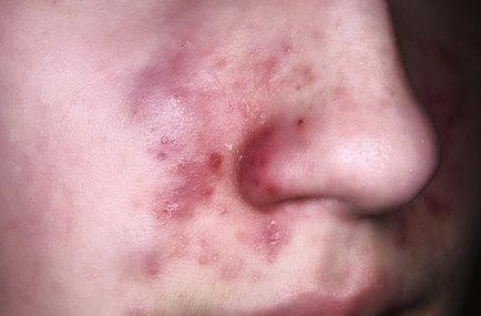 Înroșire și descuamare a pielii din jurul nasului cauze si tratament homeopatie (piele) Roșeață și descuamarea pielii din jurul nasului, cauzele si tratamentul homeopatiei