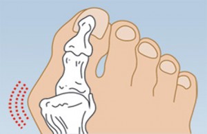 törött lábujj rögzítése ízületi fájdalom a jobb kezében mit kell tenni