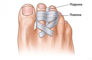 Lábujj törés :: Dr. Csicsai Lenke - InforMed Orvosi és Életmód portál :: lábujjtörés