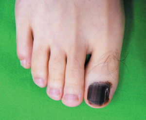 zúzódás a köröm alatt vagy gomba betegség nail hand gombák