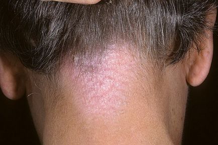 atópiás dermatitisz fejbőr