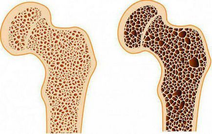 Osteoporosis szakrendelés
