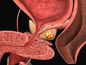 Krónikus prosztatagyulladás a fibrózis stádiumában