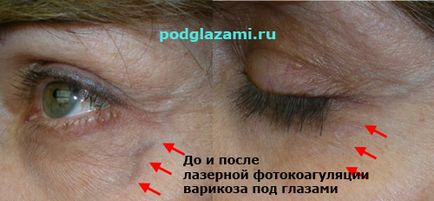 A szem alatti visszér okoz, A visszér 6 tünete és szövődményei - Egészség | Femina