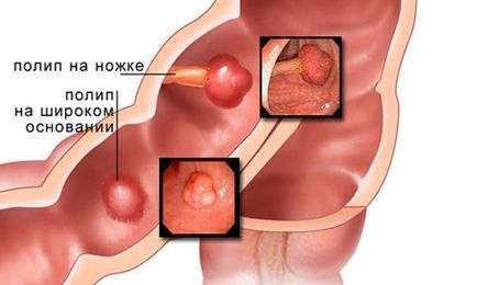 gyomor polip tünetei a prostatitis l- re vonatkozó jogorvoslat