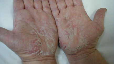 dermatitis az ujjak között