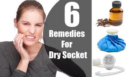 6 remèdes maison pour Alvéolite - Traitements naturels & amp; Cure For Dry Socket, la santé Lady Care (comment faire la pâte d'huile de clou de girofle) 6 remèdes maison pour Alvéolite - Traitements naturels & amp; Cure For Dry Socket, Lady soins de santé