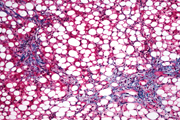 Alcoolique Liver Disease (Без кейворда) La maladie alcoolique du foie
