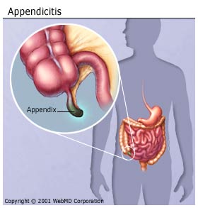 Appendicite symptômes, les causes, la chirurgie et la récupération