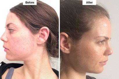Klar Brilliant Laser Review kann Laser-Behandlungen machen die Haut jünger aussehen, Glamour
