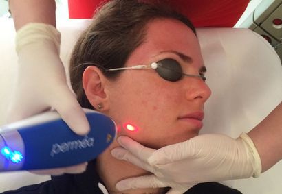 Laser clair Brilliant examen peut Traitements Laser rendre votre peau plus jeune, glamour