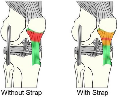 Wie ein Patellasehne Band kann Ihren Jumper verschlechtern - Knie