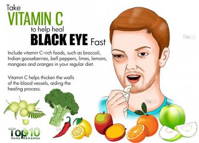 Rid von einem blauen Auge Schnell, Top 10 Home Remedies Wie Get