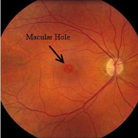 Maculaires Hole, Maison et travail optométrie soins