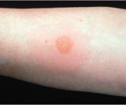 Mantoux Résultat d'essai, les soins de santé - Qsota - Trucs et astuces Médecins (résultat) Mantoux Test Résultat, Soins de santé - Qsota - Trucs et astuces Médecins