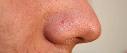 Nez et Pimples nez - Pimples intérieur Causes et traitement, Pimple