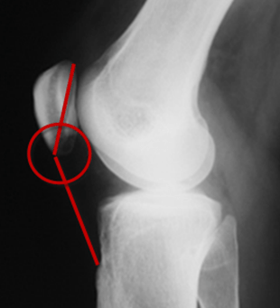 Tendon Rotulien sangles Diminution patellaire Tendinite et patellaire Tendon Strain - Mike Reinold