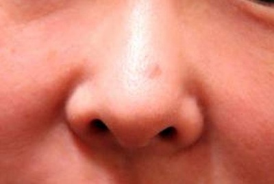 Pimple au nez - Comment faire pour se débarrasser des boutons