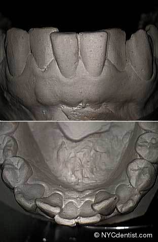 Modèles d'étude de modèles de diagnostic et modèles de maître - dentiste NYC