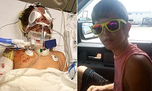 Texas Teenager verliert Bein, Finger und kann Augenlicht nach Wunderkerze Bombe explodiert verlieren, Daily Mail Online