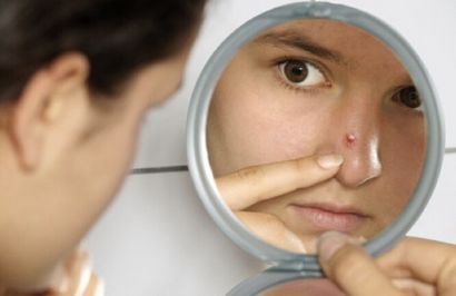 Top 10 remèdes maison pour se débarrasser de Pimple Nose