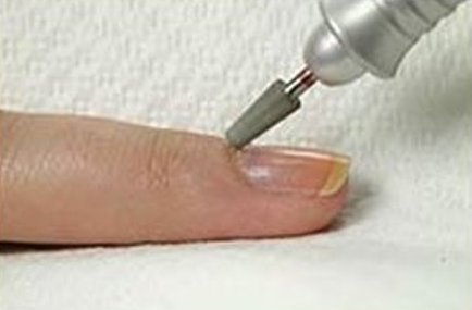 nail gomba sebészetileg