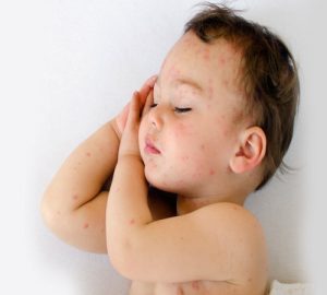 Allergia bőr vörös foltok a gyermek - ez mit jelent