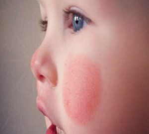 Allergia bőr vörös foltok a gyermek - ez mit jelent