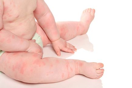 Allergia újszülött néz ki, mit kell tennie, mint hogy kezelje a terápiás elvek csecsemők
