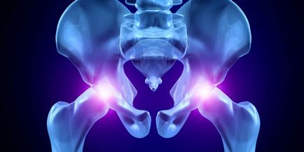 Osteoarthritis a csípő - tünetek és kezelés népi jogorvoslat, gyógyszerek és gyakorlatok