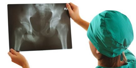 Osteoarthritis a csípő - tünetek és kezelés népi jogorvoslat, gyógyszerek és gyakorlatok