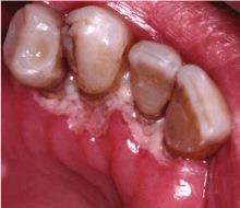 Fehér foltok a fogíny okok és a kezelés