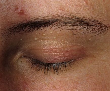Fehér pattanás a szemhéj szemében - típusainak kezelésére és fehér pattanás szemhéj szem