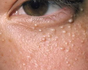 Fehér pattanás a szemhéj szemében - típusainak kezelésére és fehér pattanás szemhéj szem