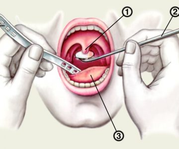 Mi pharyngoscope torok gyógyszer típusú, jelzések vizsgálata