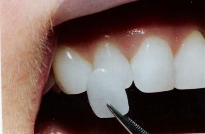Mik furnér fogak bélés a fogak