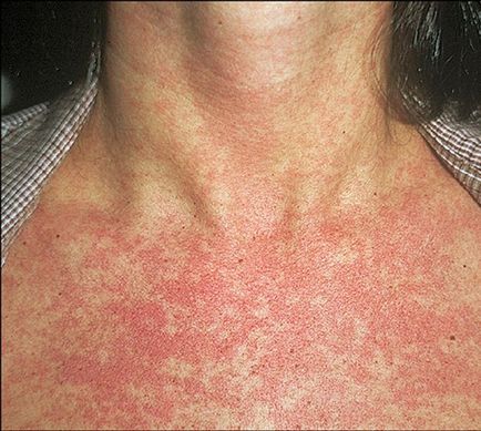 Dermatitis (fotók) - Tünetek és kezelés Felnőttek