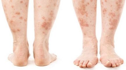 Dermatitis (fotók) - Tünetek és kezelés Felnőttek