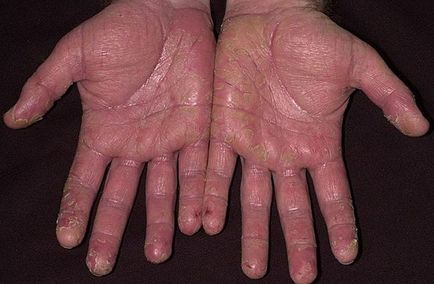 Dermatitis (fotók) - Tünetek és kezelés Felnőttek